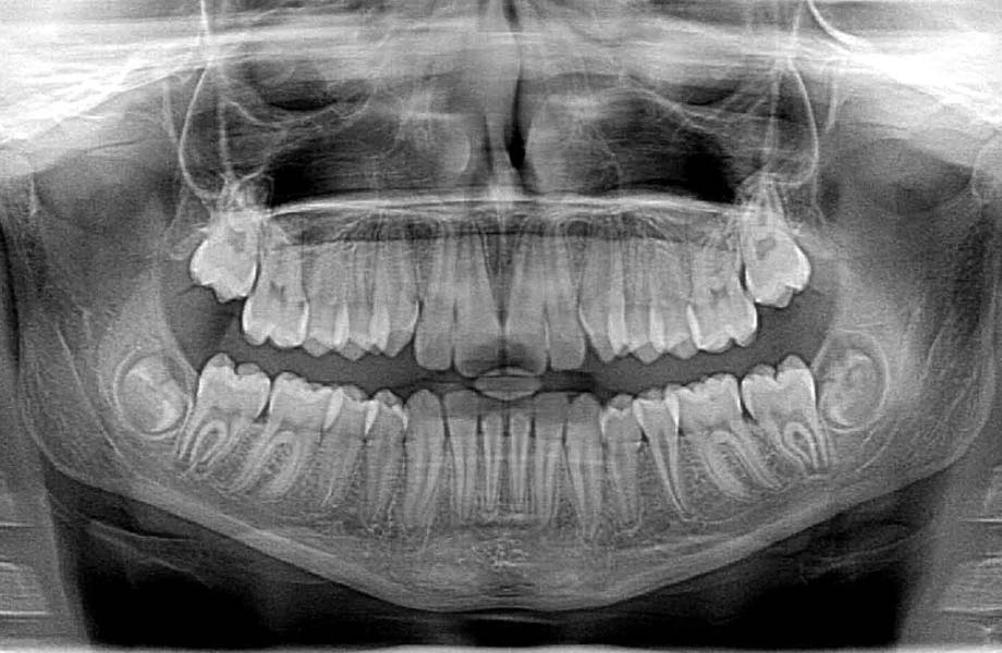 Dental Xray Image