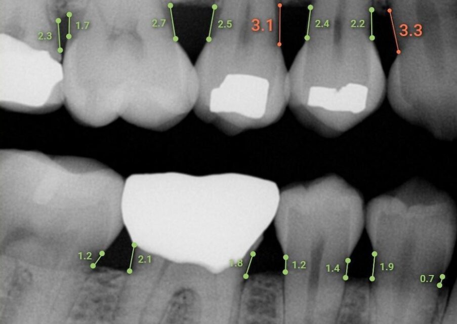 In a Dental Industry First, Overjet’s Dental Assist Receives FDA Clearance to Bring AI to the Dental Practice