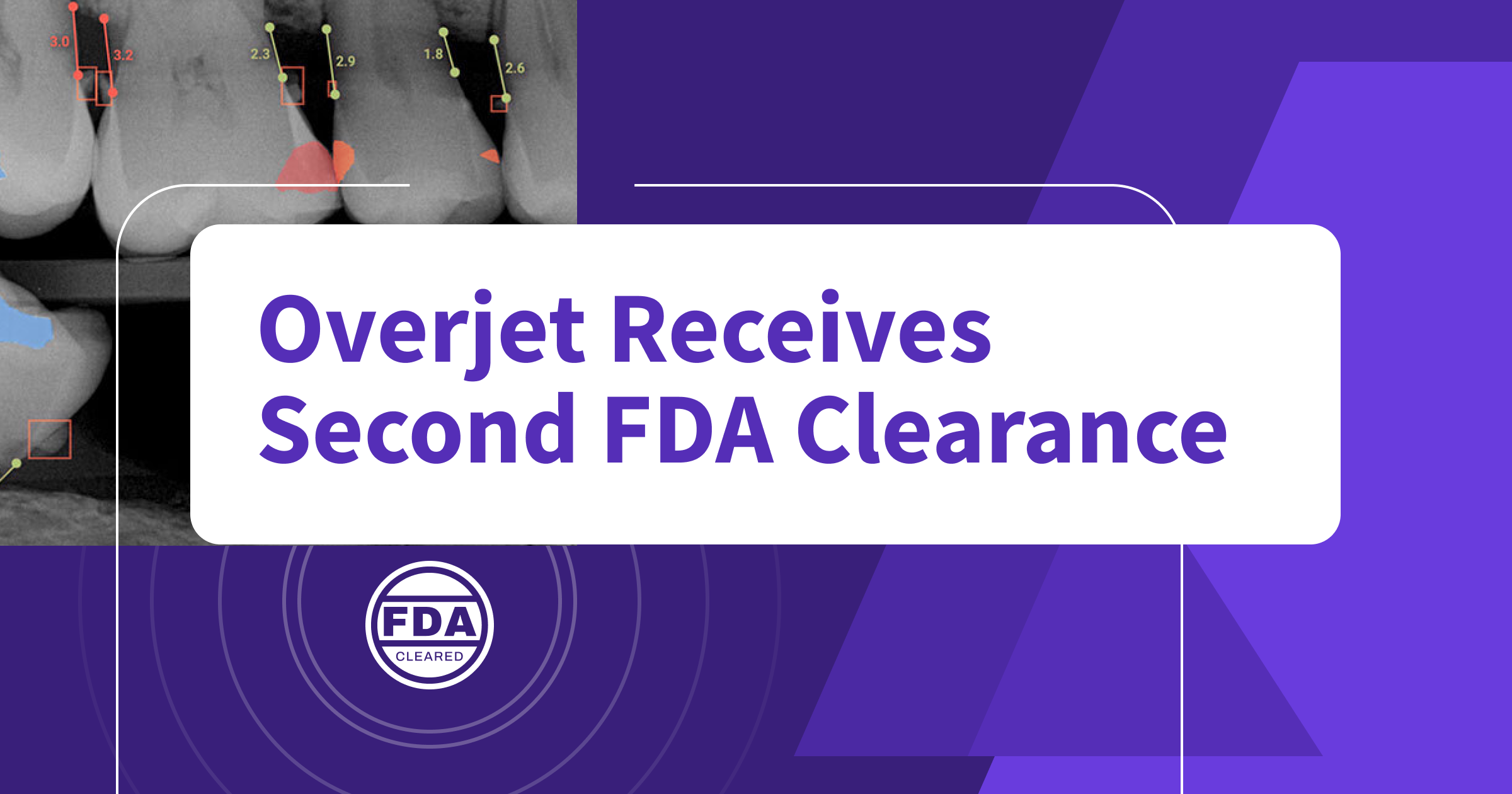 Overjet Receives Second FDA Clearance, Adding Overjet Caries Assist to the Industry’s #1 Dental AI Platform